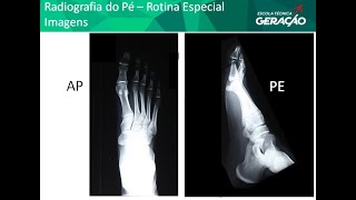 Radiografia do PÉ  AP  Perfil [upl. by Hezekiah]