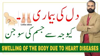 Swelling of body due to Heart disease 【Cardiac edema in HindiUrdu】 [upl. by Taub342]