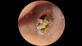 Removal of giant earwax  Ear Hygiene [upl. by Resarf]