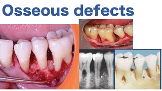 OSSEOUS DEFECTS [upl. by Arv]