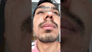 1 Month Minoxidil Journey minoxidil beard hair [upl. by Udenihc]