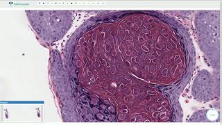 Molluscum Contagiosum  Histopathology [upl. by Nylave94]