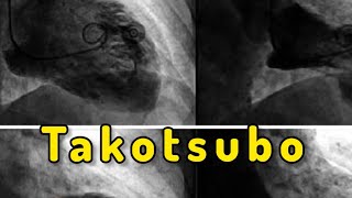 Takotsubo Cardiomyopathy “Broken Heart Syndrome” [upl. by Salter]