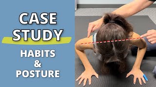 CASE STUDY The Impact of HyperMobile Habits on Posture LongTerm hypermobile posture eds [upl. by Ilenna923]