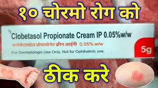 Clobetasol Cream use For एग्जिमा एलर्जी Damataitisskin rashes  soriasis  Review in hindi [upl. by Nhoj]