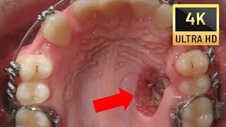 💝 HOW BRACES WORK Amazing Transpositions in 4K  Before and After [upl. by Notniuq893]