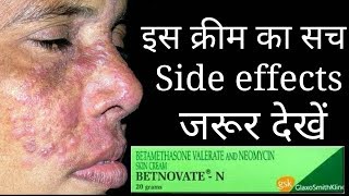 The Shoking Truth Of Betnovate N Cream Betnovate n cream Review and Side effects [upl. by Marlena]