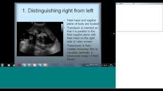 Fetal Echocardiography Basic Views by Dr Sejal Shah [upl. by Nikola]