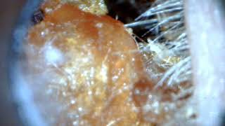 Ear wax removal mega deep jobson horn [upl. by Wilda278]