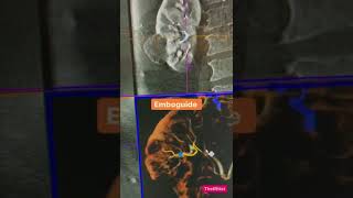 Embolization of renal angiomyolipoma with emboguide software [upl. by Purse]