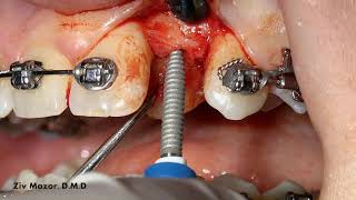 Dr Ziv Mazor Uses Dentatus ANEW Narrow Diameter Implant [upl. by Laresa]