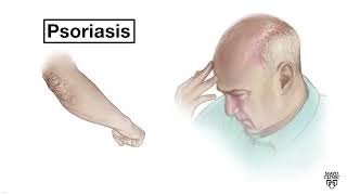 Mayo Clinic Minute  Psoriasis of the scalp [upl. by Marleen863]