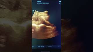 Placenta previa  Low Lining placenta previa pregnancy ultrasound pregnant mbbs shorts video [upl. by Steinman]