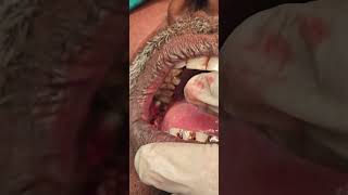 Verrucous carcinoma buccal mucosa excision unedited cautery laser  Dr Hitesh Patel [upl. by Alvar]