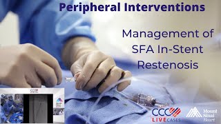 Management of SFA InStent Restenosis [upl. by Eladal]