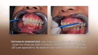 Desensitizing Procedure using the NEW TEETHMATE DESENSITIZER from Kuraray [upl. by Netsrijk401]