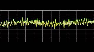 Hemangioma  Rife Frequencies [upl. by Colene855]