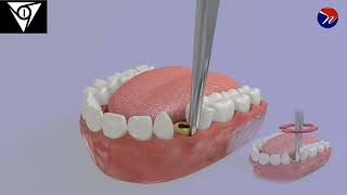 M1 Atraumatic ankylosed root extraction using pre elevator 1 [upl. by Liliane641]