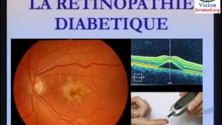 Rétinopathie diabétique définition physiopathologie Classification [upl. by Ibib235]