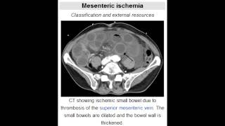 Acute Mesenteric Ischemia Adult Intussusception Infants [upl. by Deny724]