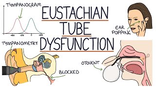 Understanding Eustachian Tube Dysfunction [upl. by Eiser871]