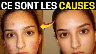 Quelles Sont les Causes des Boutons sur le Visage  Voir les 4 Principaux Facteurs [upl. by Seiden]