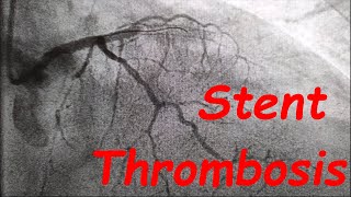 Acute Stent Thrombosis due to Pt noncompliance CardiologyForum [upl. by Akoek]