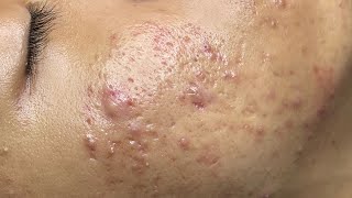 ACNE TREATMENT VU QUYNH MI  Perennial Blackheads On Boy Face 2024FULL [upl. by Aihseya]