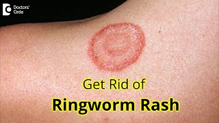 7 GREAT Tips for Prevention amp Treatment of RINGWORM RASH Dr Amrita Hongal Gejje  Doctors Circle [upl. by Hayyikaz213]