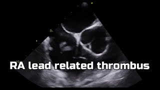 Thrombus in RA lead [upl. by Paugh913]