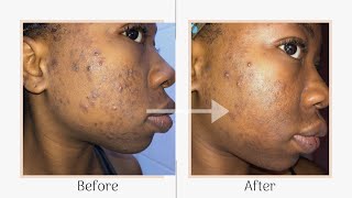 Skincare Series  Mandelic Acid Peel Two Week Progress amp Peeling Progress pictures included [upl. by Scuram474]