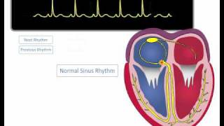 ECG Rhythm Review Sinus Rhythm Sinus Bradycardia Sinus Tachycardia [upl. by Nonnerb]