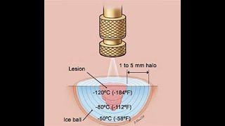 Cryotherapy or Cryoablation or Cryosurgery or Cold therapy  Overview Indications Types Uses [upl. by Lyrret507]