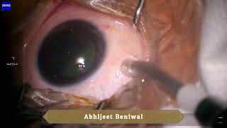 Intravitreal chemotherapy for retinoblastoma [upl. by Acile112]