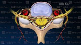 Arterial Vasospasm with Resulting Embolic Stroke [upl. by Orlan]