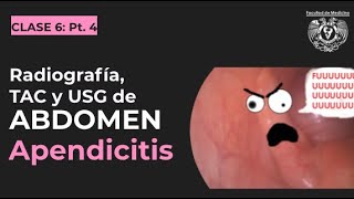 064  Apendicitis en radiografía TAC y ultrasonido [upl. by Massiw]