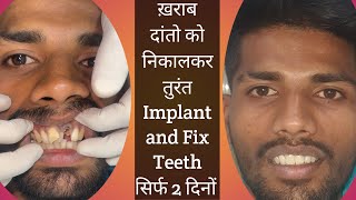 Replace missing teeth with implant and get fix teeth in 2 Days [upl. by Notnek657]