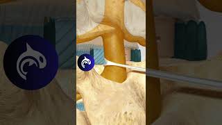 See what a Posterior Lumbar Interbody Fusion of the Spine looks like in 3D Animation [upl. by Stephan]