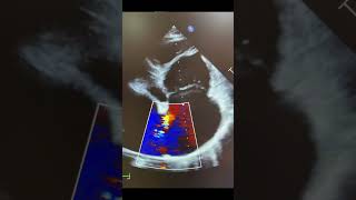 Atrial septal defect in adult [upl. by Gwyneth510]