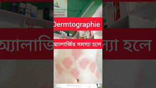 Allergy urticaria Dermtographie Bengali [upl. by Sera]