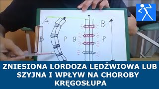 Spłycona zniesiona lordoza lędźwiowa  Przyczyna chorób kręgosłupa  Ćwiczenia  🇵🇱 🇪🇺 [upl. by Alemak]