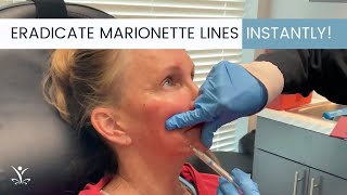 Get Instant Results with Filler for Marionette Lines [upl. by Enneillij]