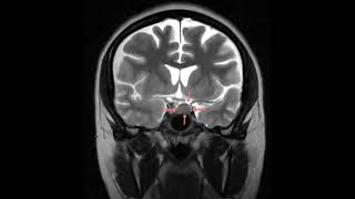 Pituitary Adenoma causing left visual disturbance [upl. by Hedi]