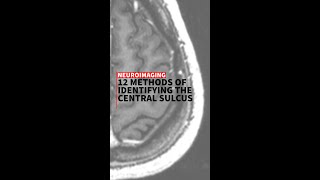 12 methods to identify the central sulcus [upl. by Aiden]