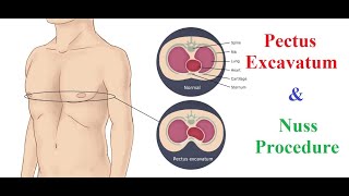 Pectus Excavatum and the Nuss Procedure [upl. by Mastat122]