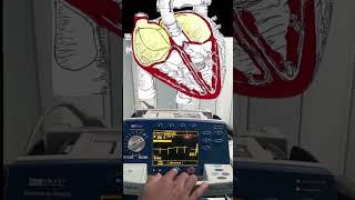 Atrial Fibrillation Cardioversion Video and Animation 🫀🔌 medical cardiology [upl. by Itak]