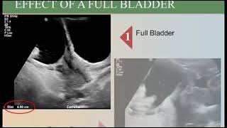 How to Identify  Assess amp Evaluate Placenta On Ultrasound [upl. by Anniram]