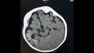 Encepalofacial angiomatosisSturge  Weber syndrome [upl. by Bartolemo849]