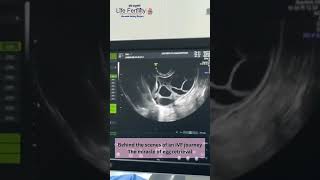 collecting mature eggs from your ovaries lifefertility  viralvideos  doctor  ivf  baby [upl. by Derr299]