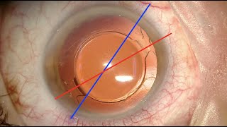 Recolocación inmediata de lente intraocular tórica rotada [upl. by Bilek]